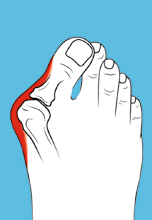 Hallux Valgus